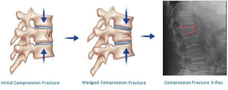 Compression fracture diagram